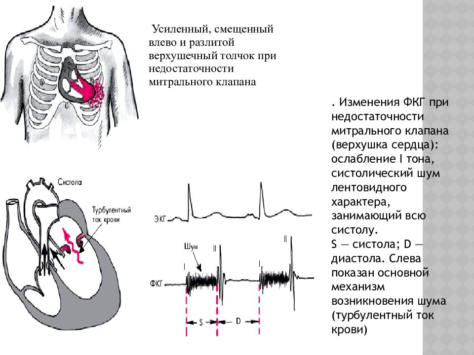 Аускультативная картина аортального стеноза