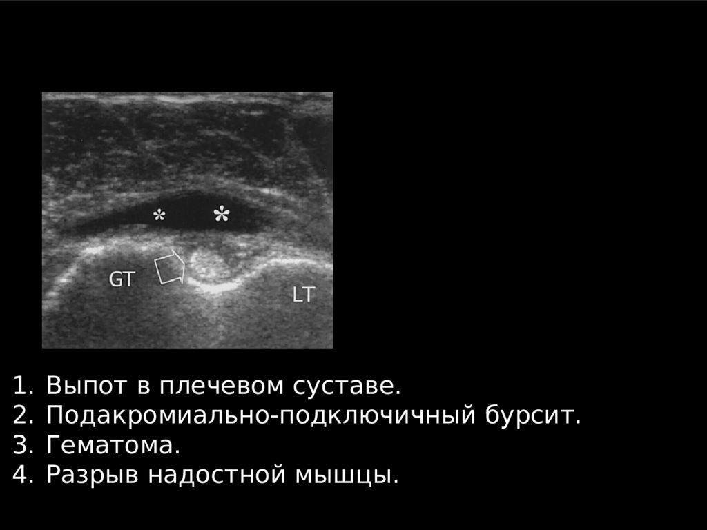 Узи плечевого. УЗИ плечевого сустава норма. УЗИ анатомия плечевого сустава. Бурсит плечевого сустава на УЗИ. Субакромиальная сумка плечевого сустава УЗИ.