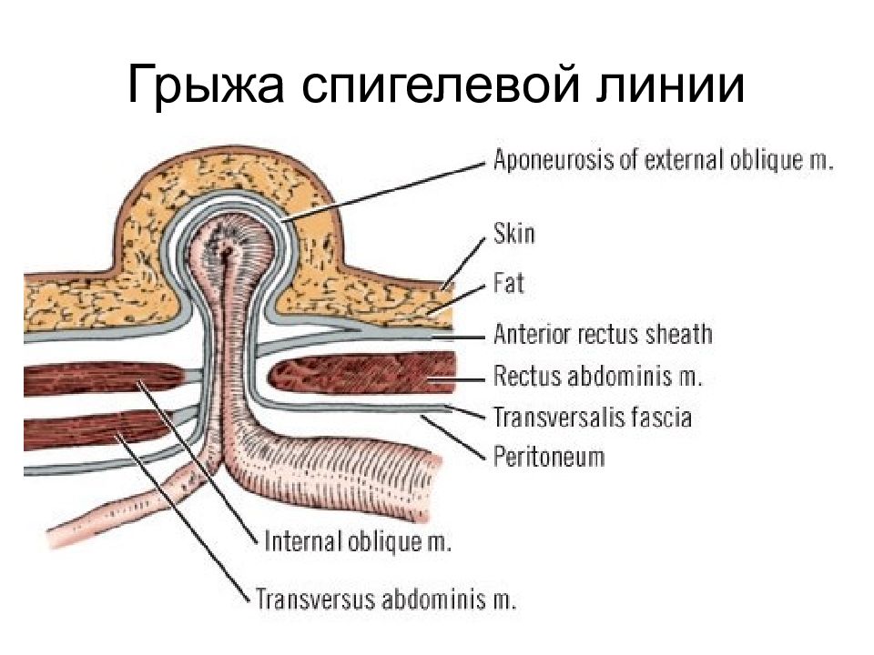 Грыжа спигелиевой линии живота анатомия. Грыжи полулунной (спигелиевой) линии. Спигелиевая линия живота грыжа.