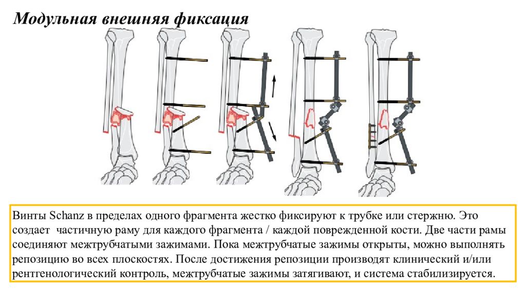 Фиксация это