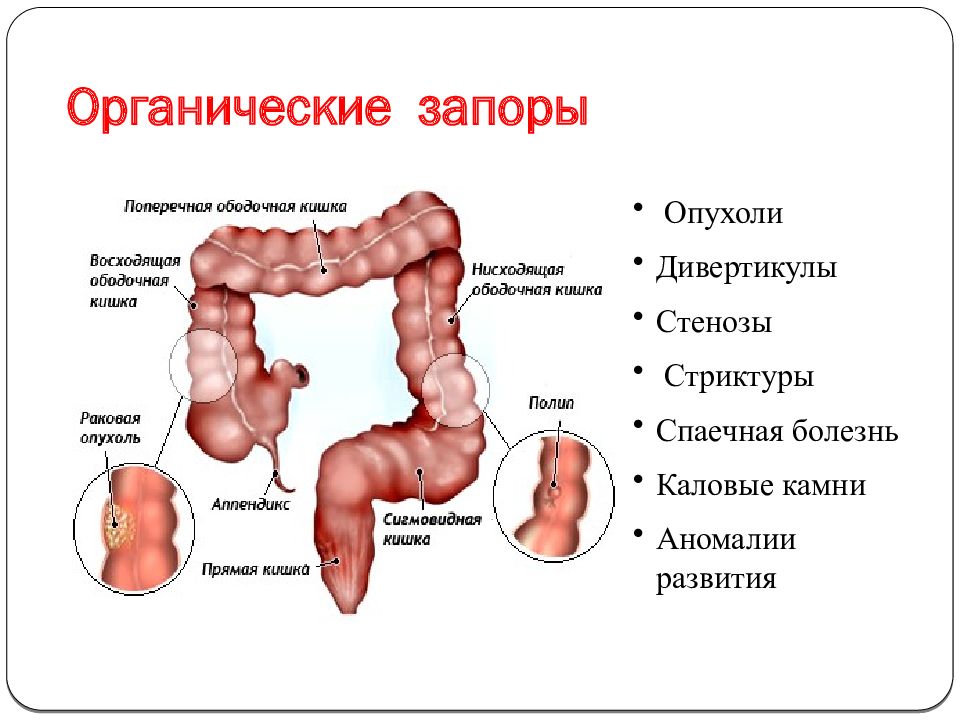 Схема болезни кишечника