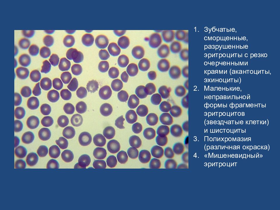 Фрагменты формы. Эхиноциты эритроциты. Эхиноциты стоматоциты. Формы эритроцитов эхиноциты сфероциты. Полихроматофилия эритроцитов.