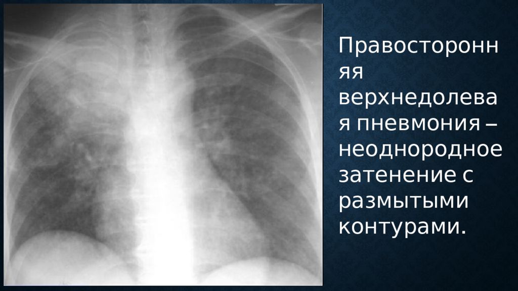 Правосторонняя пневмония. Очаговая верхнедолевая пневмония рентген. Рентген верхнедолевой правосторонней пневмонии. Правосторонняя верхнедолевая пневмония на рентгене. Левосторонняя верхнедолевая пневмония рентген.