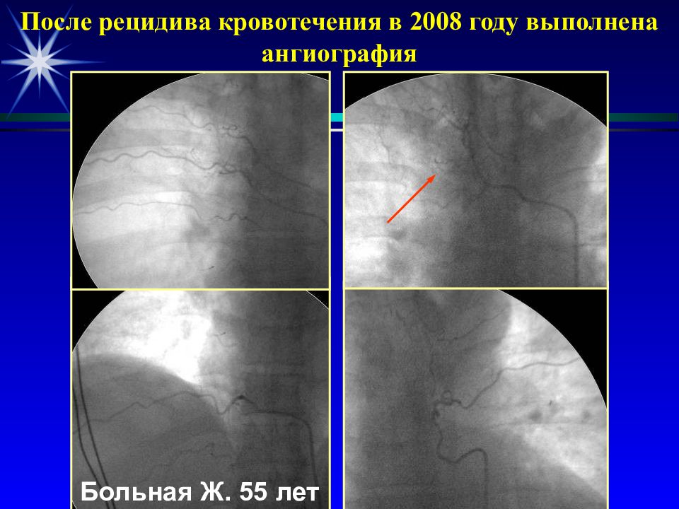 Причины возникновения рецидивов после ортодонтического лечения. Рецидивирующее лечение. После рецидива. После рецидива. Факторы риска фп.