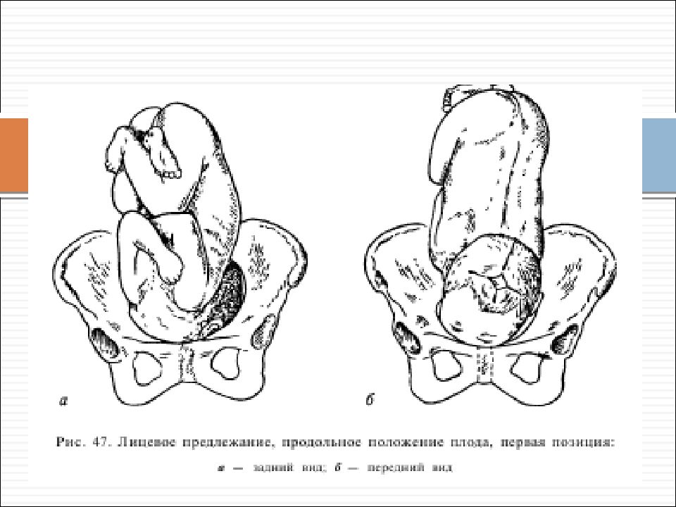 Продольное предлежание плода при беременности фото