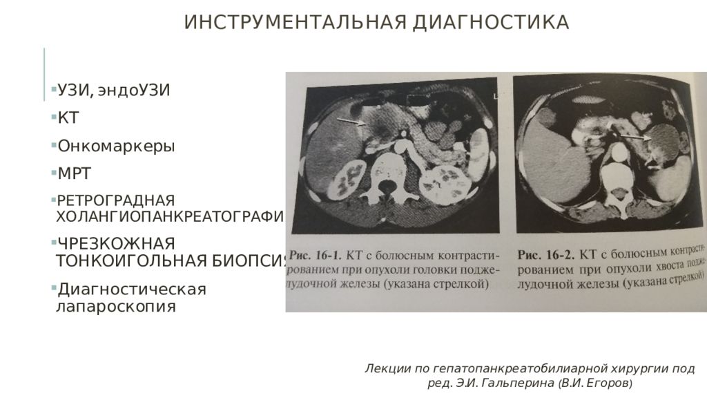 Доброкачественные опухоли поджелудочной железы презентация