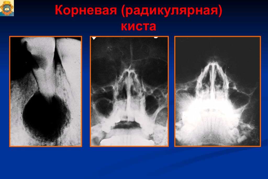 Опухоли опухолеподобные поражения и кисты кожи лица презентация