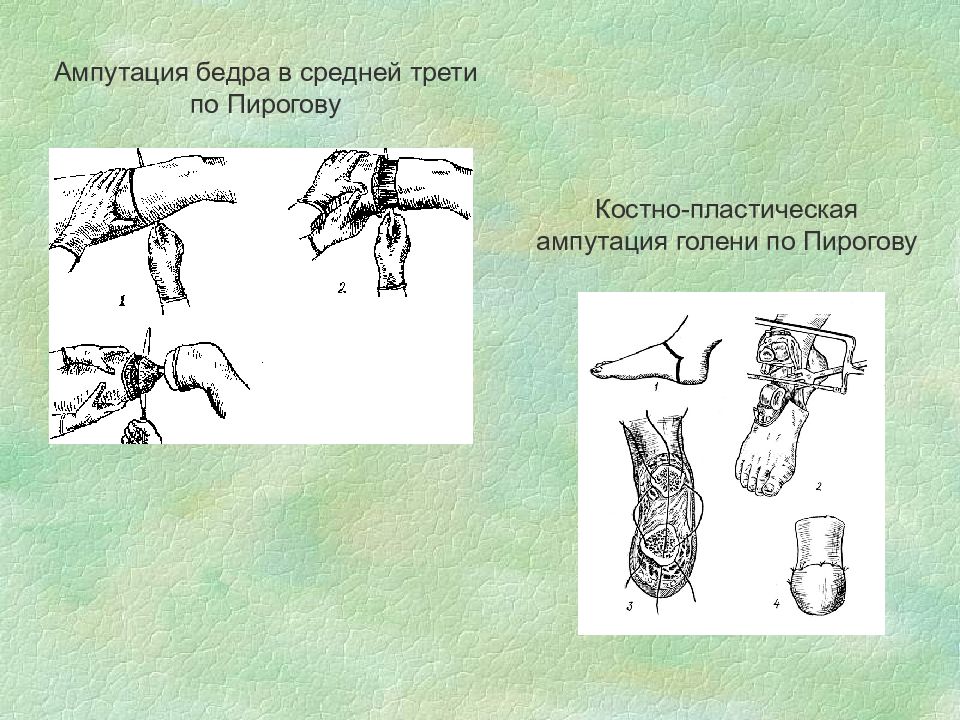 Ампутация конечности мкб. Трехмоментная ампутация бедра по н.и Пирогову. Костно пластическая ампутация по Пирогову. Костно-пластическая ампутация голени по Пирогову инструменты. Костно пластическая ампутация стопы по Пирогову инструменты.