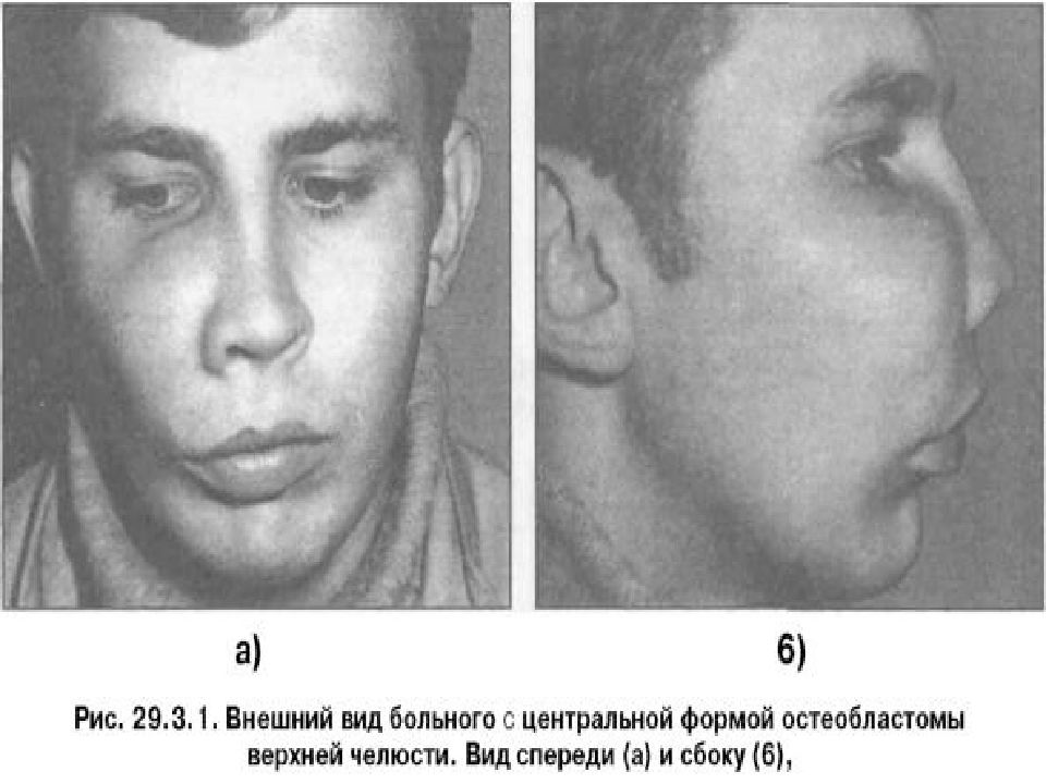 Доброкачественные опухоли челюстно лицевой области классификация презентация