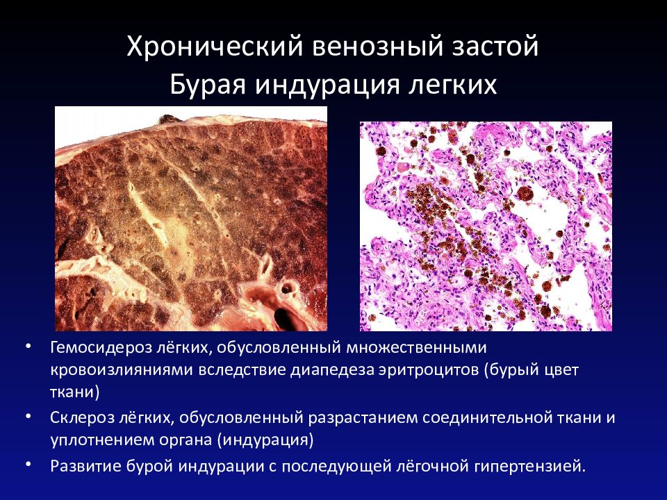 Венозный застой в печени. Бурая индурация легких патанатомия. Хроническое венозное полнокровие легких бурая индурация. Бурая индурация легких это в патологии. Бурая индурация легких патанатомия исход.