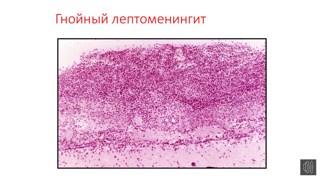 Детские инфекции патанатомия презентация