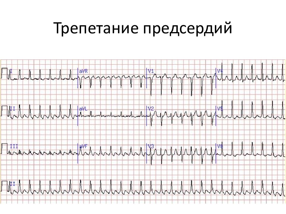 Мерцательная аритмия карта вызова