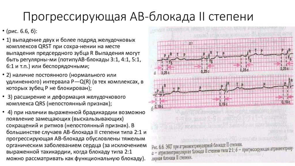 Что такое блокада сердца. ЧСС при АВ блокаде 2 степени. ЭКГ признаки АВ блокады 2 степени Мобитц 1. АВ блокада 2 ст мкб. АВ блокада 2 степени или блокированная экстрасистолия.