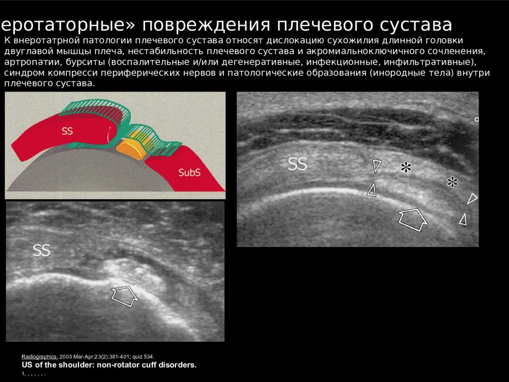 Узи плечевого. Протокол УЗИ плечевого сустава бурсит. УЗИ суставов плечевого сустава. Бурсит плечевого сустава на УЗИ. Патология плечевого сустава на УЗИ.