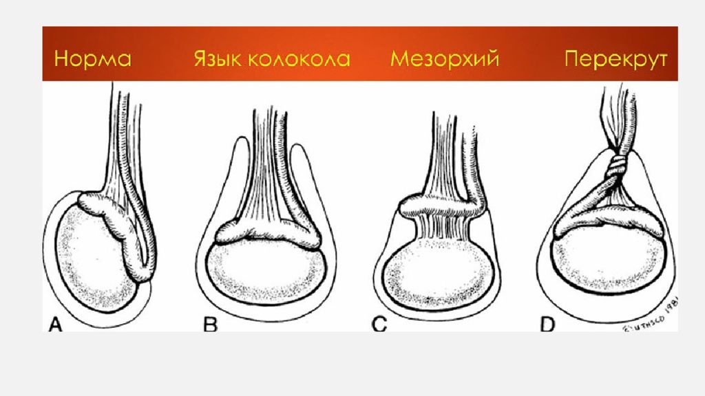 Перекрут яичка симптомы у мужчин