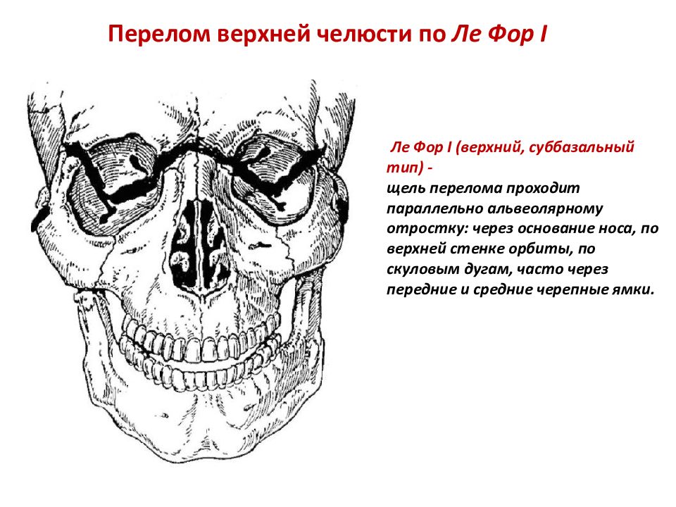 Перелом верхней челюсти картинки