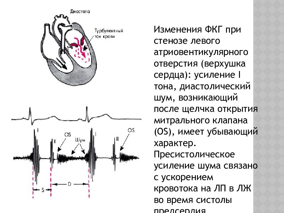 Аускультативная картина при митральном стенозе сердца включает тест