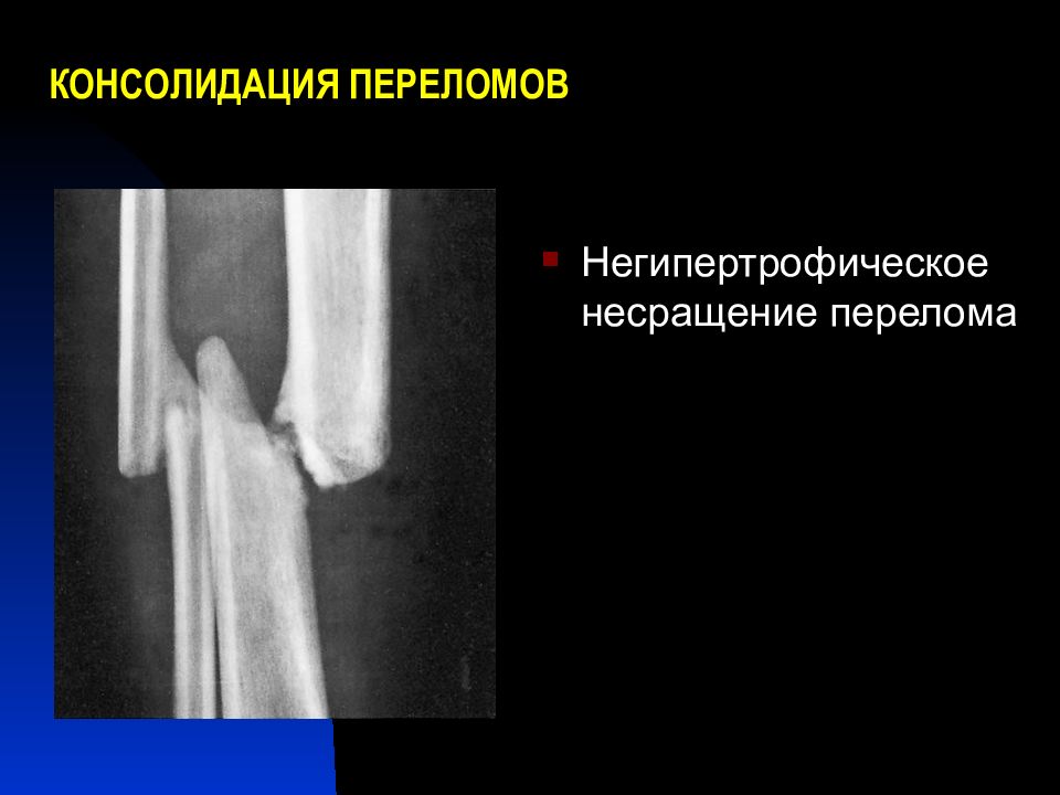 Что такое консолидация перелома. Консолидирующийся перелом на рентгене. Консолидированный перелом рентген. Стадии консолидации перелома. Замедленная консолидация переломов.