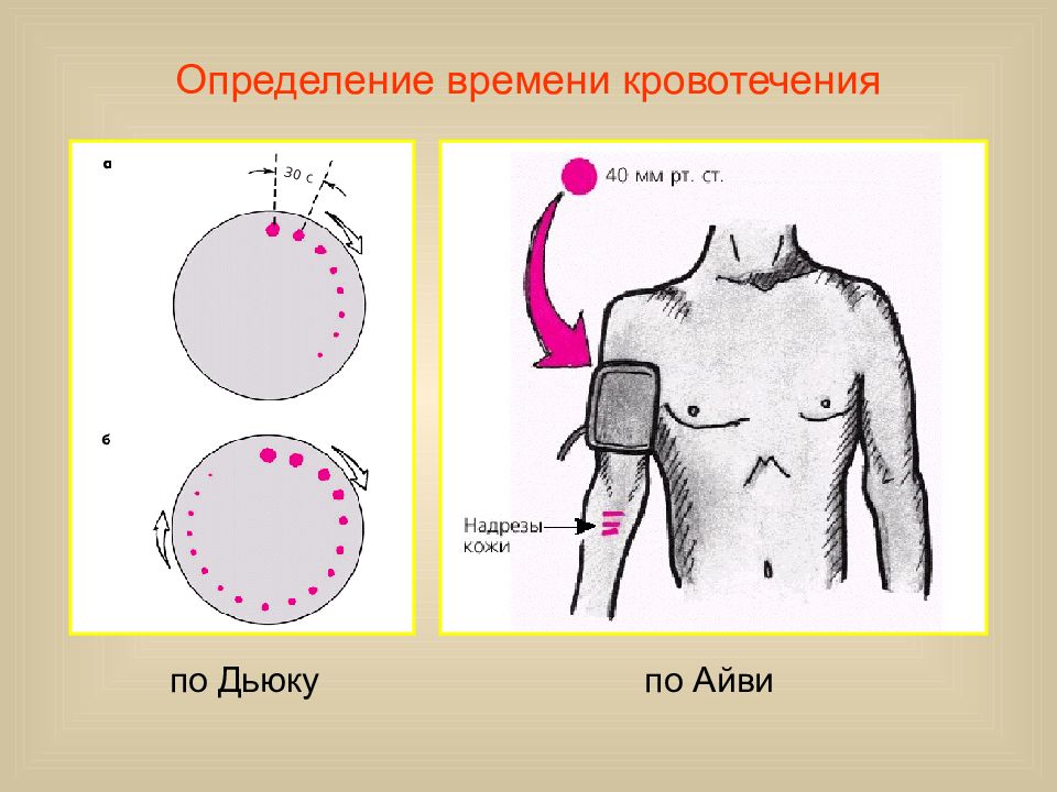 Длительность кровотечения. Кровотечения по Дьюку норма. Продолжительность кровотечения по Дьюку. Длительность кровотечения по Дюке. Определение времени кровотечения.