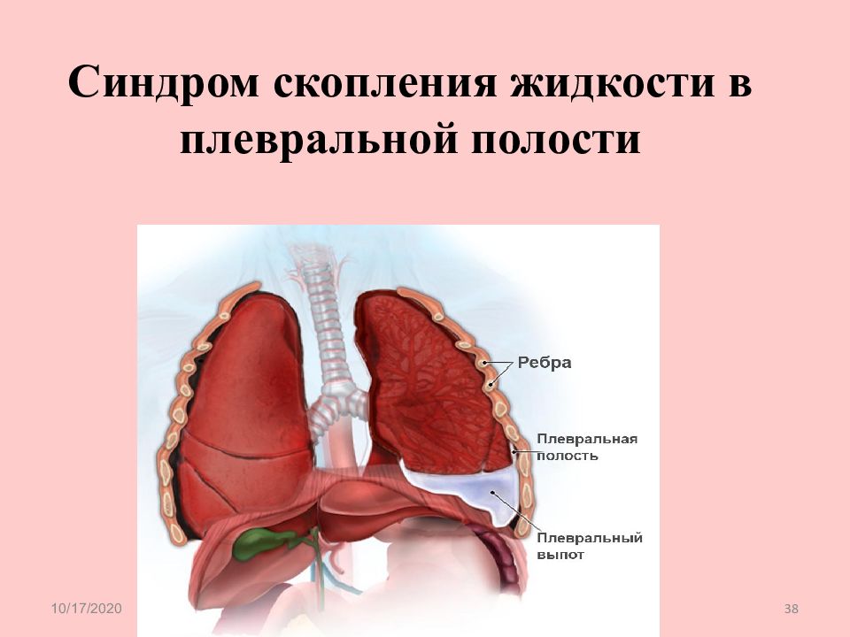 Скопление в плевральной полости. Жидкость в плевральной полости. Скопление жидкости в плевральной полости. Накопление жидкости в плевральной полости. Синдром скопления жидкости в плевральной полости.