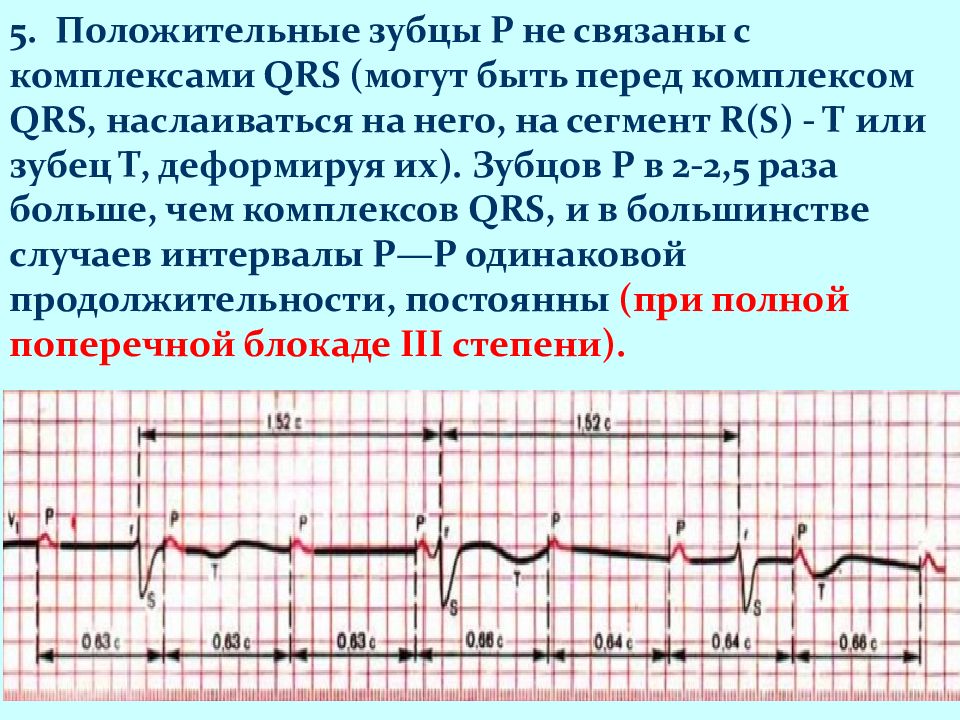 Экг при нарушениях ритма и проводимости презентация