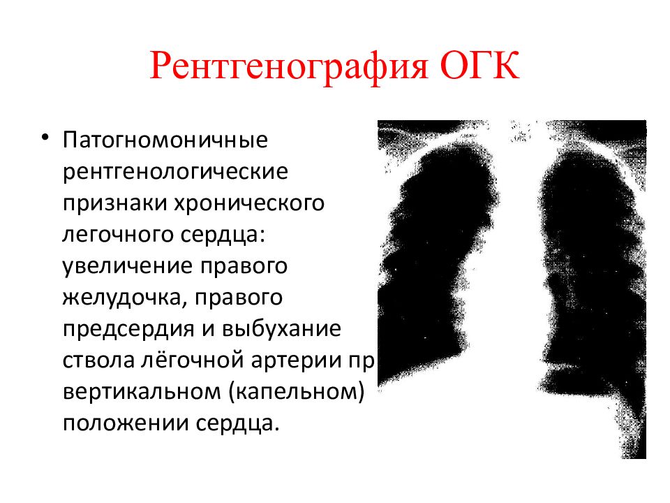 Симптомы легочного туберкулеза презентация