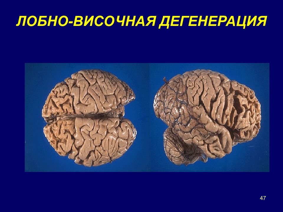 Височно лобная деменция. Лобно височная деменция гистология. Лобно височная дегенерация. Лобно-подкорковая деменция. Подкорковая сосудистая деменция.