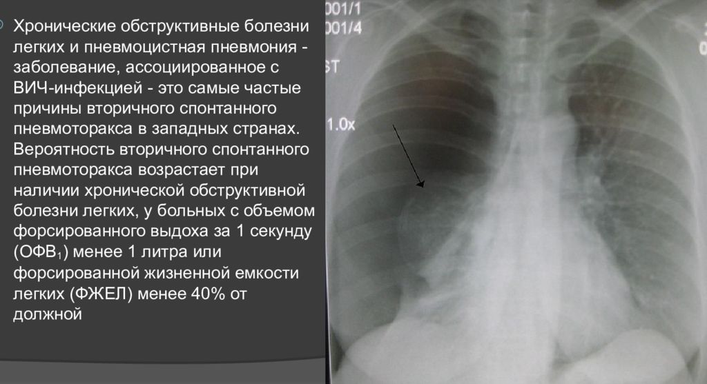 Спонтанный пневмоторакс презентация