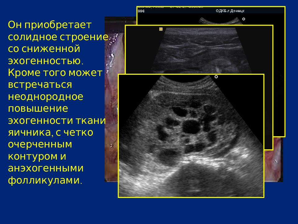 Эхогенность повышена