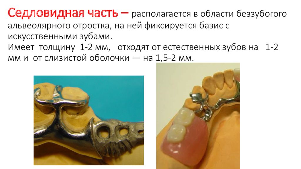 Строение бюгельного протеза. Элементы бюгельного протеза. Бюгельные протезы составные части.