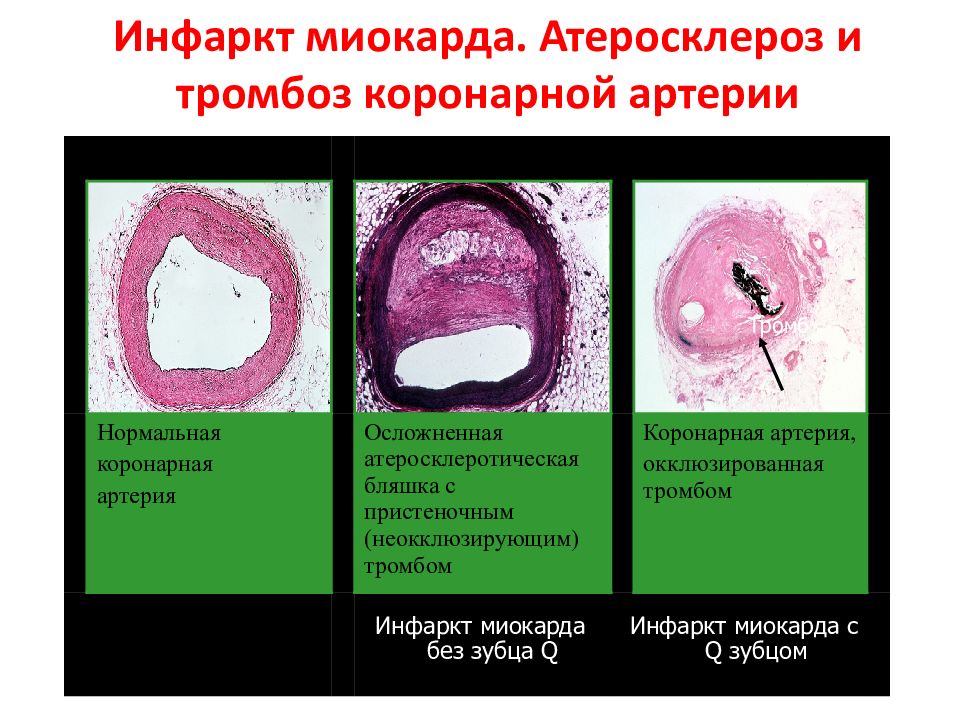 Атеросклероз и инфаркт миокарда различия. Инфаркт миокарда с пристеночным тромбом. Бляшка инфаркт миокарда. Тромб в коронарной артерии. Инфаркт миокарда атеросклероз.