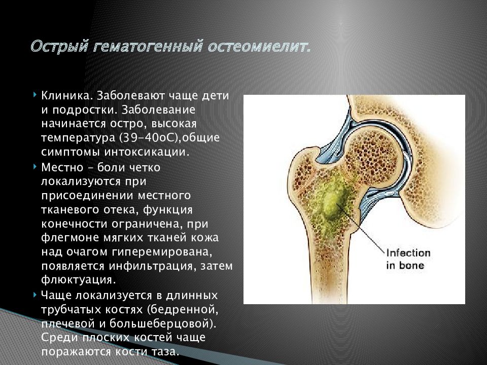 Презентация гнойные заболевания костей и суставов