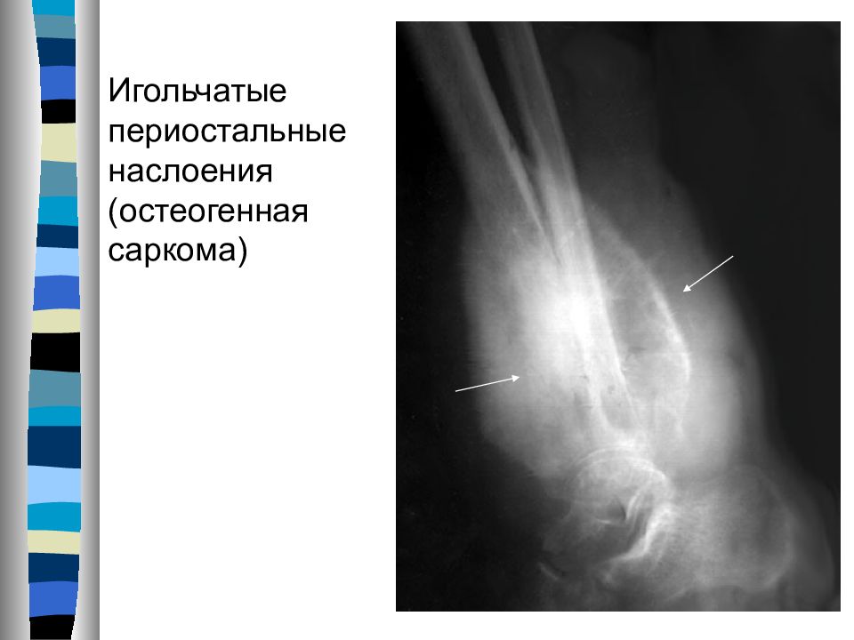 Клиническая картина при остеогенной саркоме в начале заболевания выражается следующими признаками