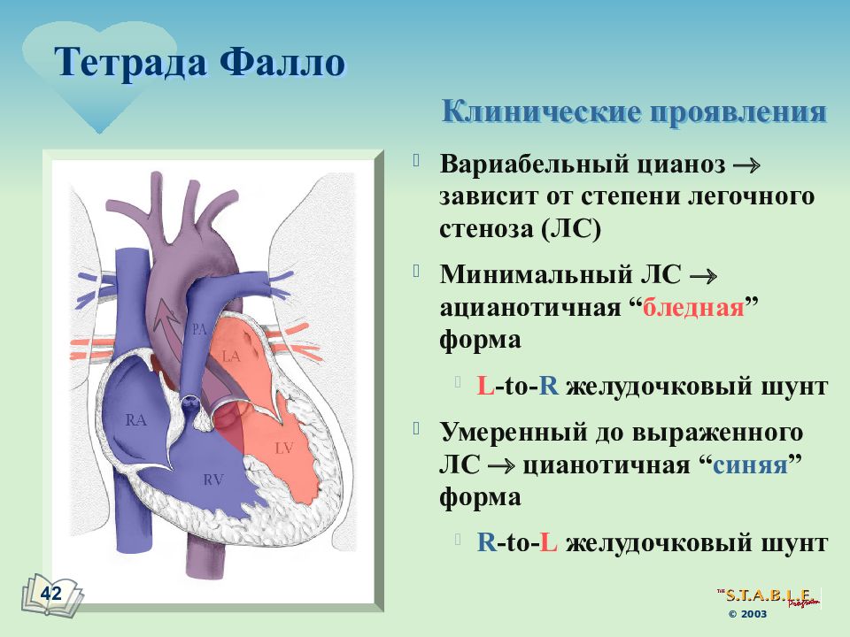 Тетрада фалло схема