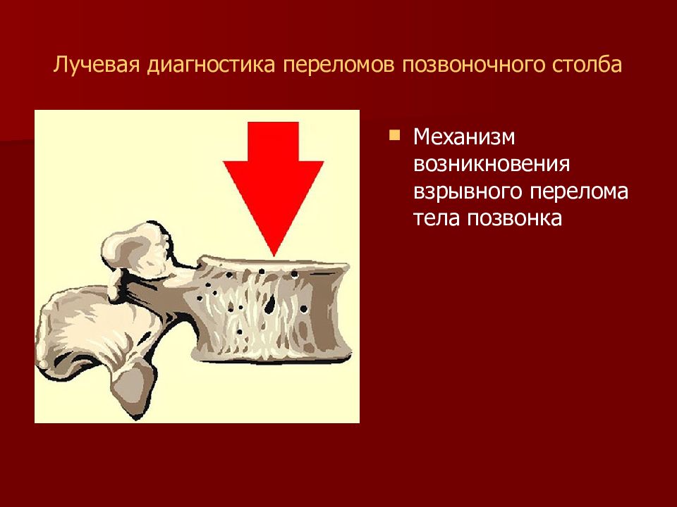 Диагностика переломов. Лучевая диагностика переломов. Механизм взрывного перелома. Способы лучевой диагностики переломов. Диагностика переломов прикол.