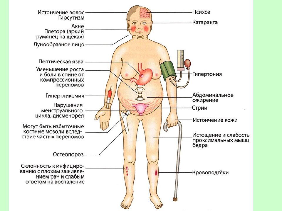 После длительного приема. Побочный эффект действия глюкокортикоидов. Осложнения длительного приема ГКС:. Побочные эффекты глюкокортикоидов при длительном применении. Осложнения системной ГКС терапии.