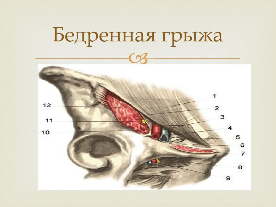 Бедренная грыжа анатомия. Бедренная грыжа сосудистая лакуна. Бедренные грыжи топографическая анатомия.