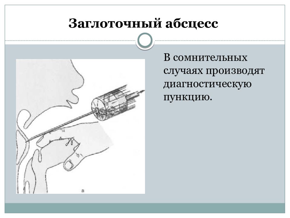 Заглоточный абсцесс. Диагностическая пункция абсцесса. 26. Схема вскрытия заглоточного абсцесса.