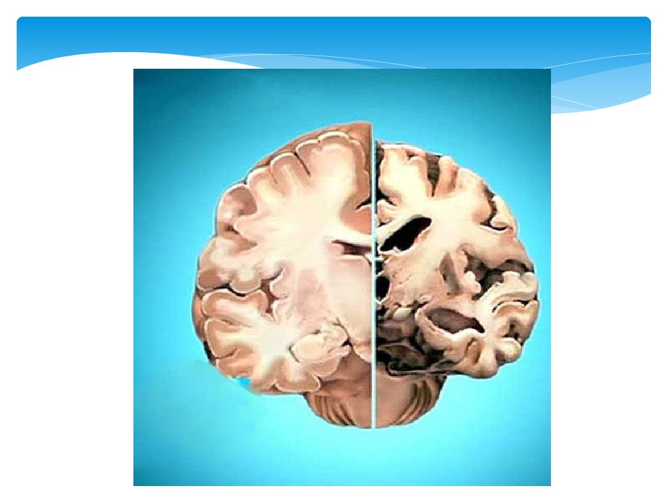 Деменция головы. Мозг человека при болезни Альцгеймера. Фронтотемпоральная деменция. Хвороба Альцгеймера. Деменция и Альцгеймер.