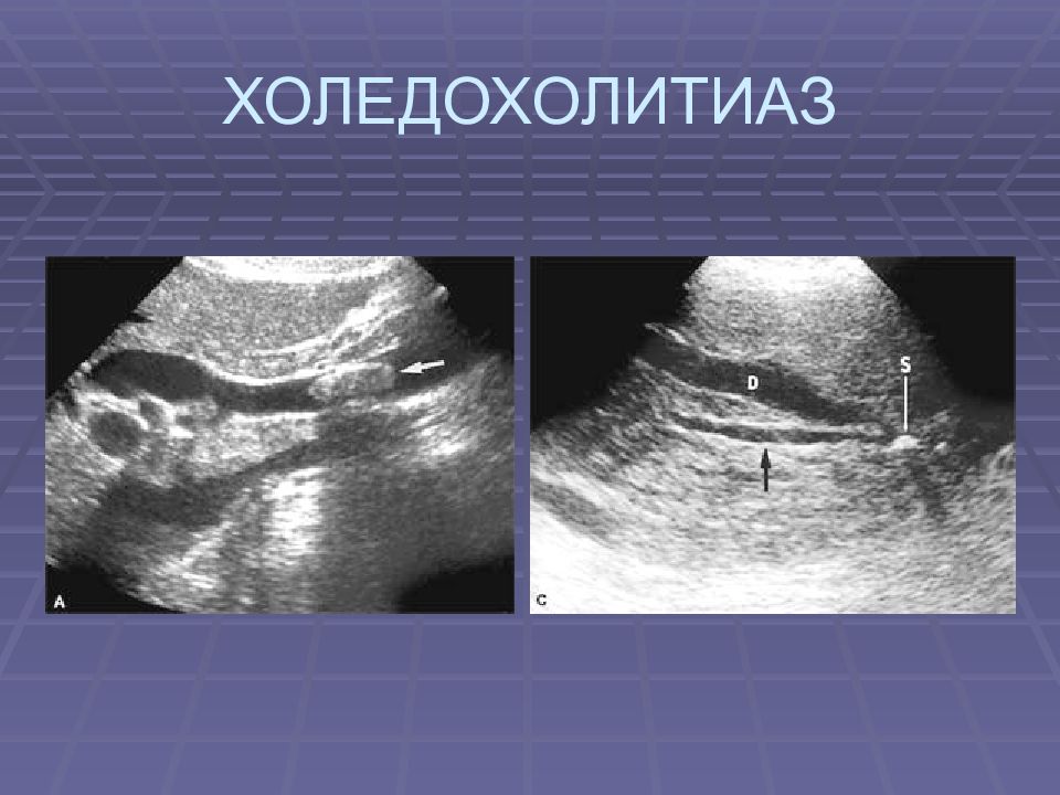 Узи картина. Ультразвуковое исследование холедохолитиаза. Конкременты холедоха УЗИ. УЗИ картина холедоха. Расширенный холедох на УЗИ.