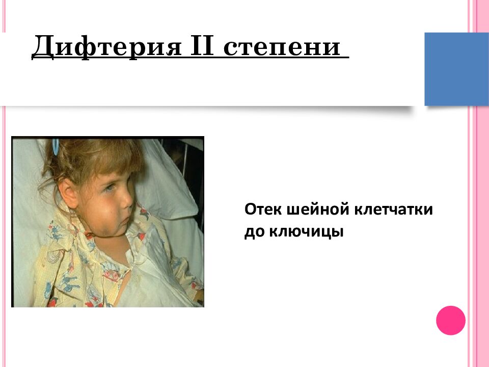 Дифтерия II степени