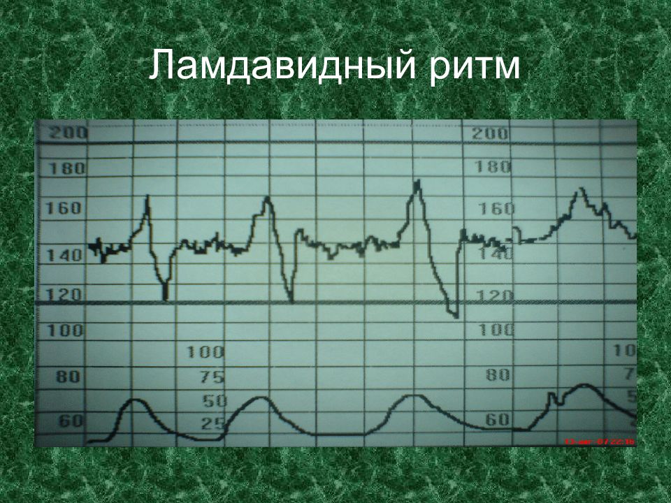 Ктг. Вариабельность сердечного ритма по КТГ. Прямая КТГ. Сальтаторный ритм на КТГ. КТГ презентация.