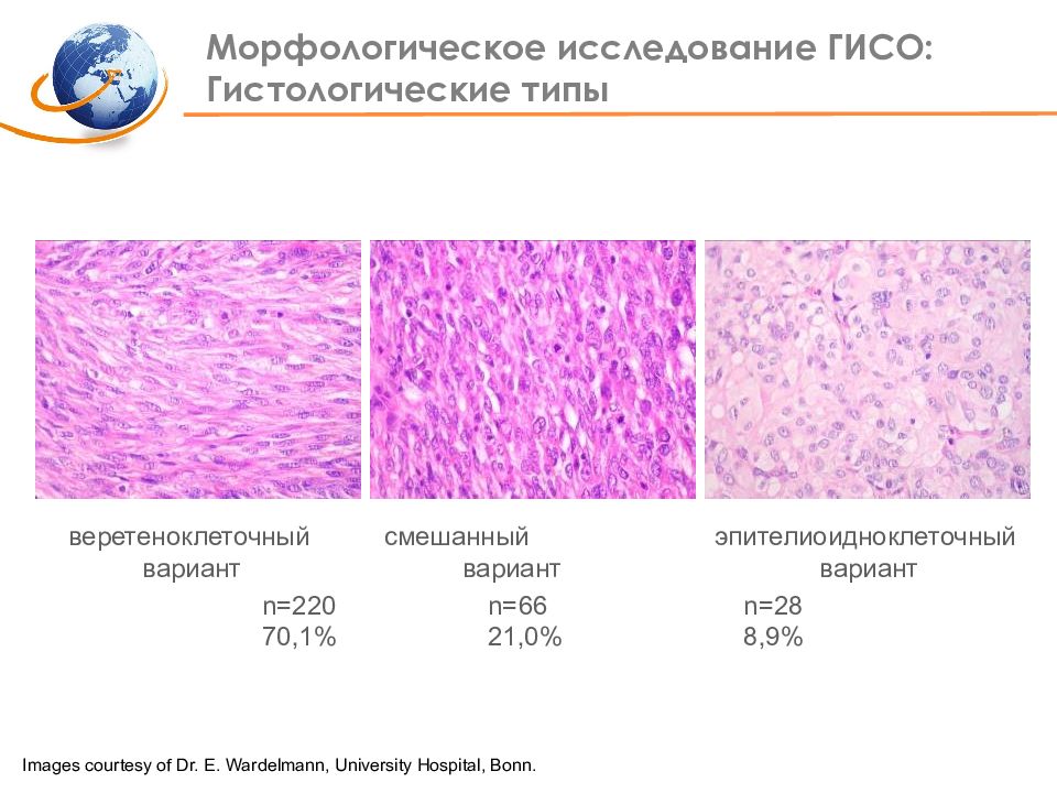 Морфологическое исследование. Гистологические типы ГИСО. Gist опухоль гистология строение. Гастроинтестинальная стромальная опухоль гистология.