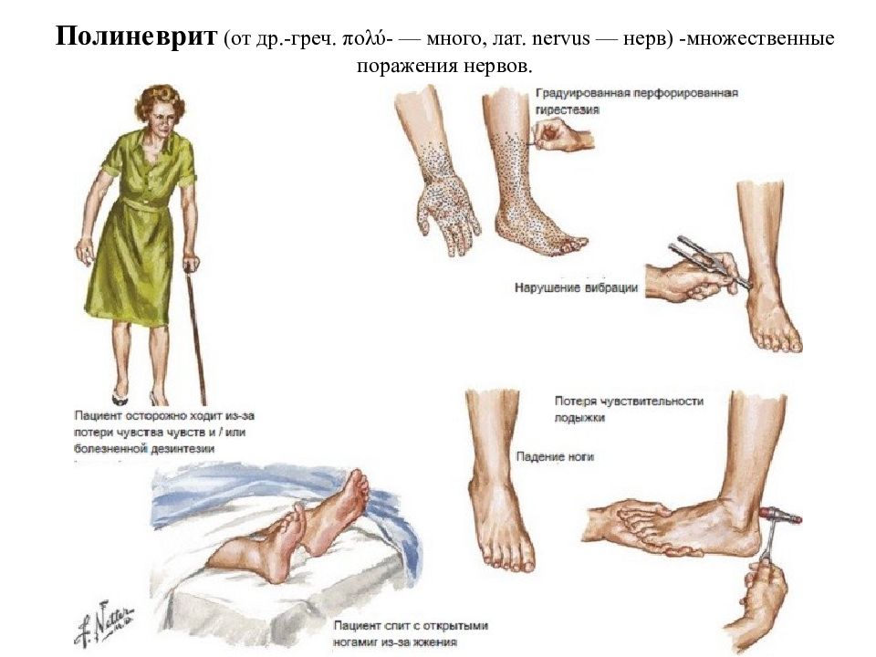 Диабетическая полинейропатия картинки