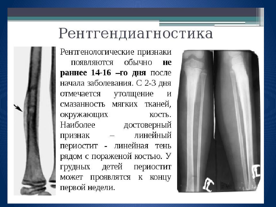 Симптомом острого остеомиелита. Рентгенодиагностика острого гематогенного остеомиелита. Рентгенологические симптомы остеомиелита. Острый гематогенный остеомиелит у детей рентгенограмма. Рентгенологические признаки остеомиелита.