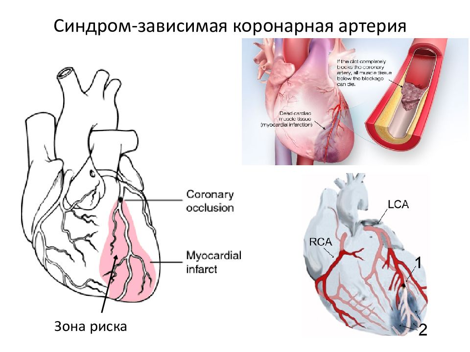 Коронарные артерии это. Феномен обкрадывания миокарда. (Синдром коронарного обкрадывания) патогенез. Синдромы инфаркта миокарда. Инфаркт зависимые коронарные артерии.