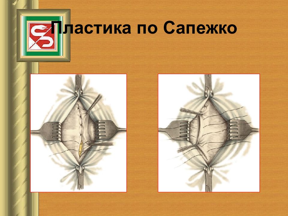 Пластика грыж по сапежко