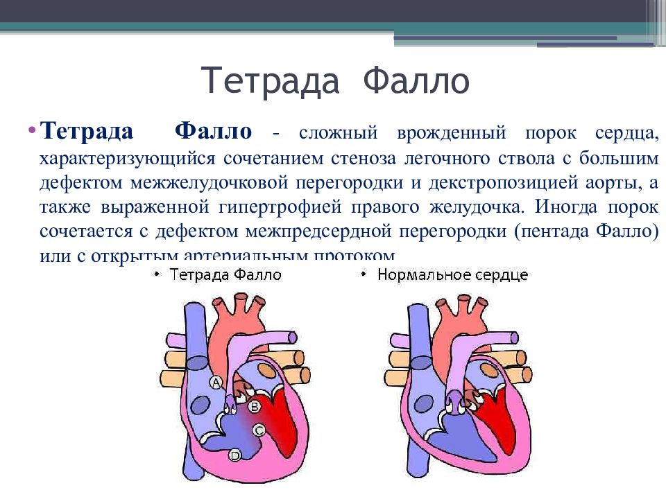 Тетрада фалло это. Тетрада и пентада Фалло. Тетра Дафала.