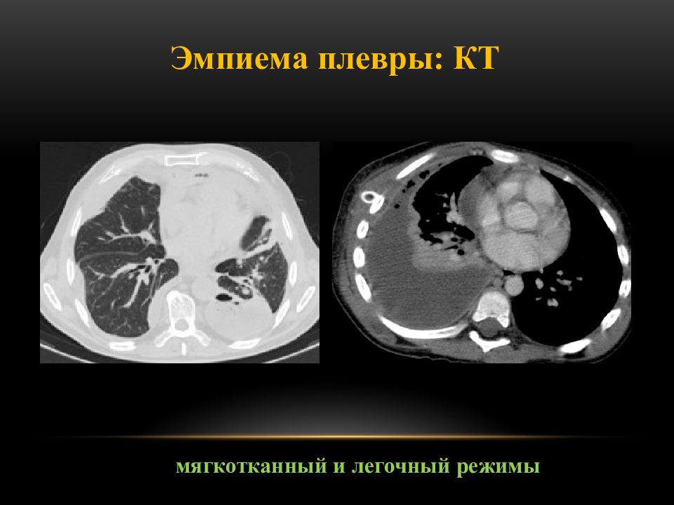 Мягкотканное образование в легком на кт. Осумкованная эмпиема плевры на кт. Эмпиема плевры кт признаки.