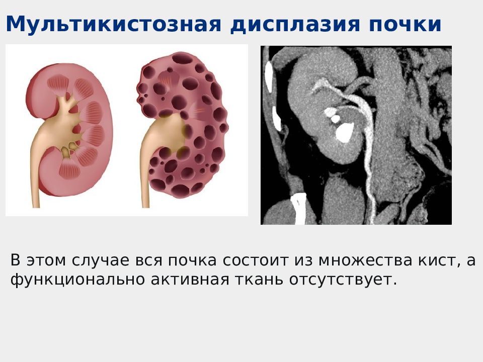 Дисплазия почки презентация